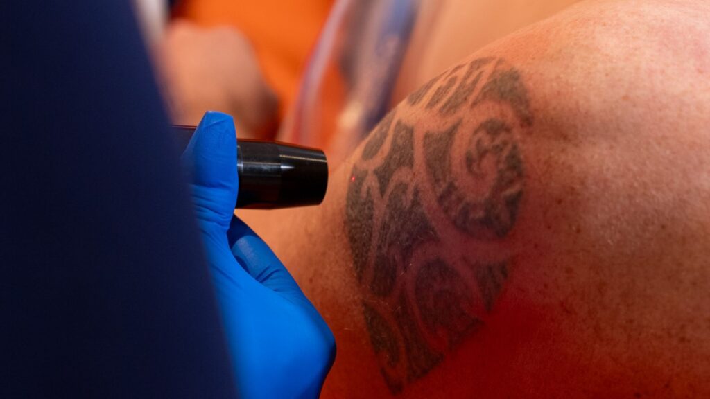 laser-tattoo-removal