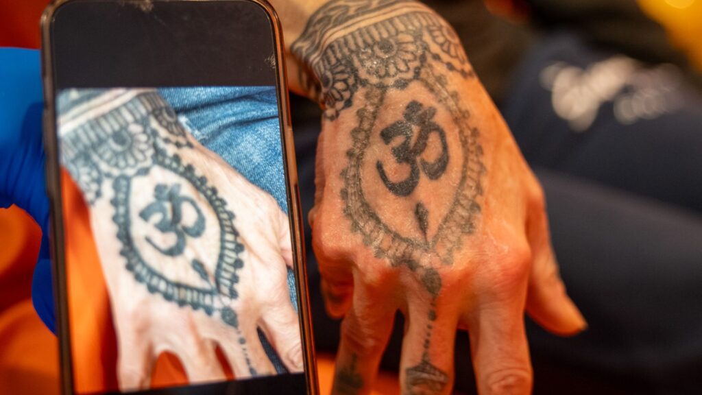 laser-tattoo-removal